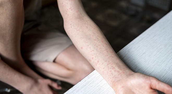 ABD'de kızamık vakaları artıyor