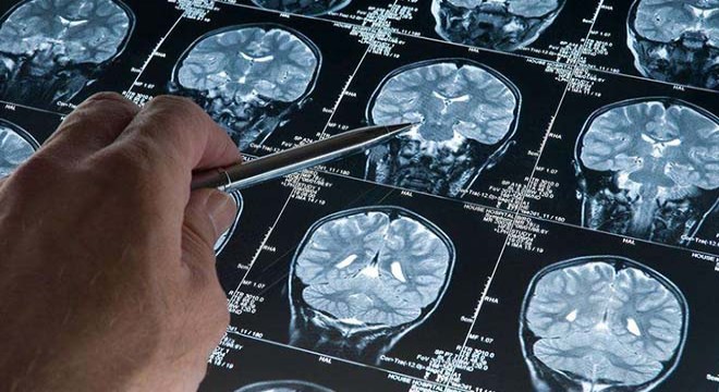 Alzheimer araştırmalarında riski artıran genetik varyant bulundu