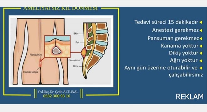 Ameliyatsız Kıl Dönmesi Tedavisi Nasıl Olur?