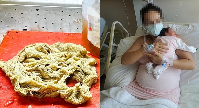 Antalya'da doğumda unutulan gazlı bez ihmaline soruşturma izni
