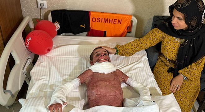 Antalya'da vücudu yanan Mustafa, deri nakliyle hayata tutundu