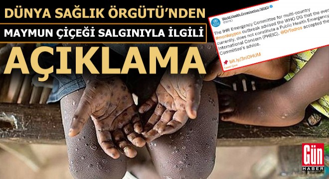 DSÖ'den maymun çiçeği salgınıyla ilgili açıklama