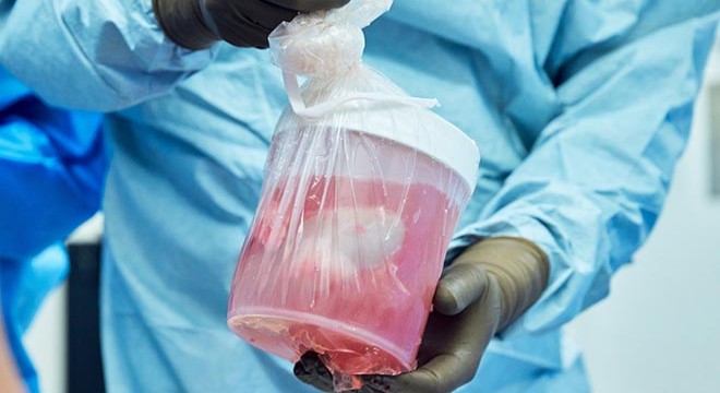 Domuz böbreği, 32 gün boyunca insan vücudunda işlevini yerine getirdi