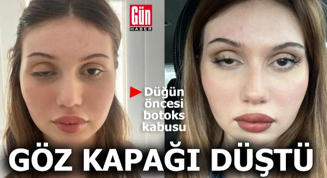 Düğün öncesi botoks kabusu: Göz kapağı düştü