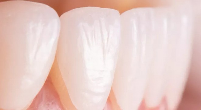 Emax Diş Kaplama Nedir?