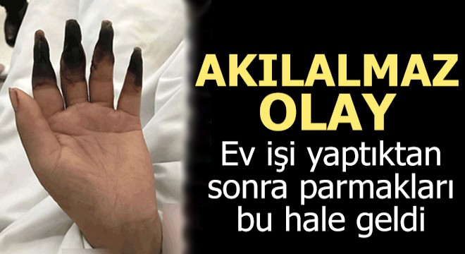 Ev işi yaptıktan sonra parmakları bu hale geldi