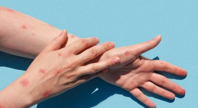 Maymun çiçeği vakaları son iki haftada üçe katlandı