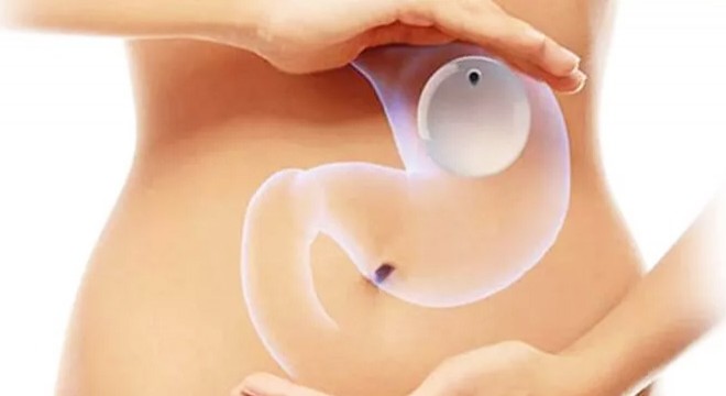 Mide Balonu ile En Hızlı Nasıl Zayıflayabiliriz?