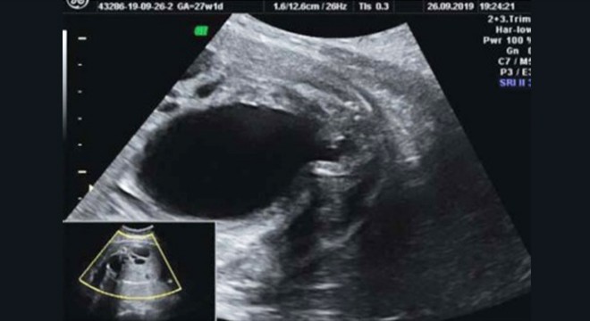 Posterior Üretral Valv Nedir?