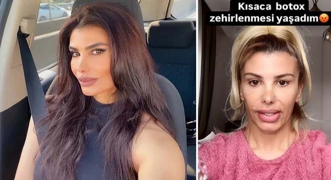 Türkücü Hatice: 'Yanlış botoks mağduru oldum'