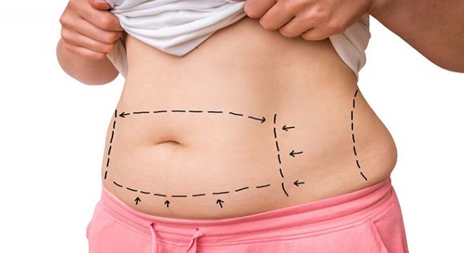 Uygun Liposuction Fiyatlarıyla Kendini Yeniden Yarat!
