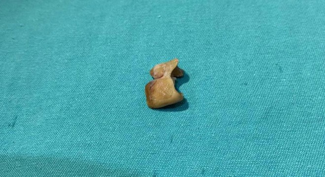 Uykusunda dişlerini yuttu, bronşundan çıktı