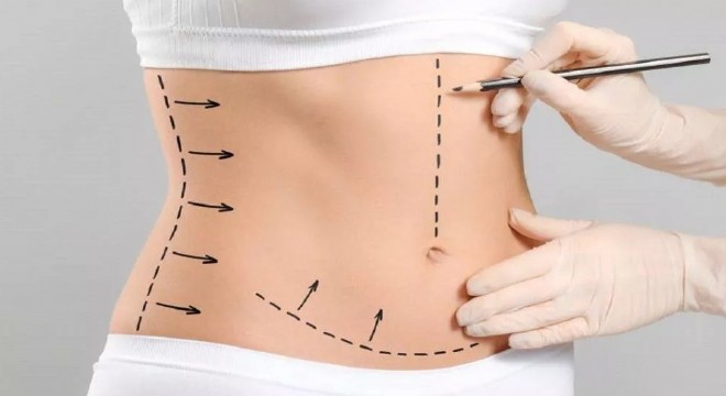 Vaser Liposuction: İnce Dokunuşlarla Şekillendirme