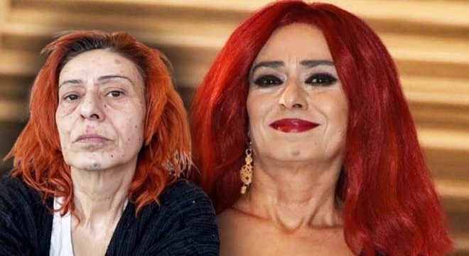 Yıldız Tilbe yüzünün nasıl yandığını anlattı