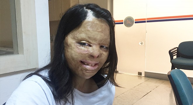 Yüzü yanan Firdevs'in hayali, vali ya da polis olmak