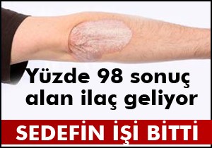 Sedef hastalarına müjde